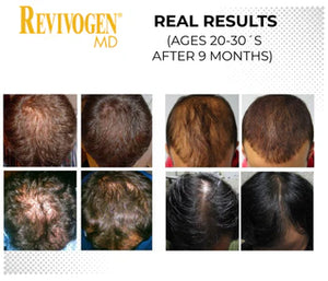 Revivogen MD 90 -Day Hair Regrowth Scalp Therapy Kit