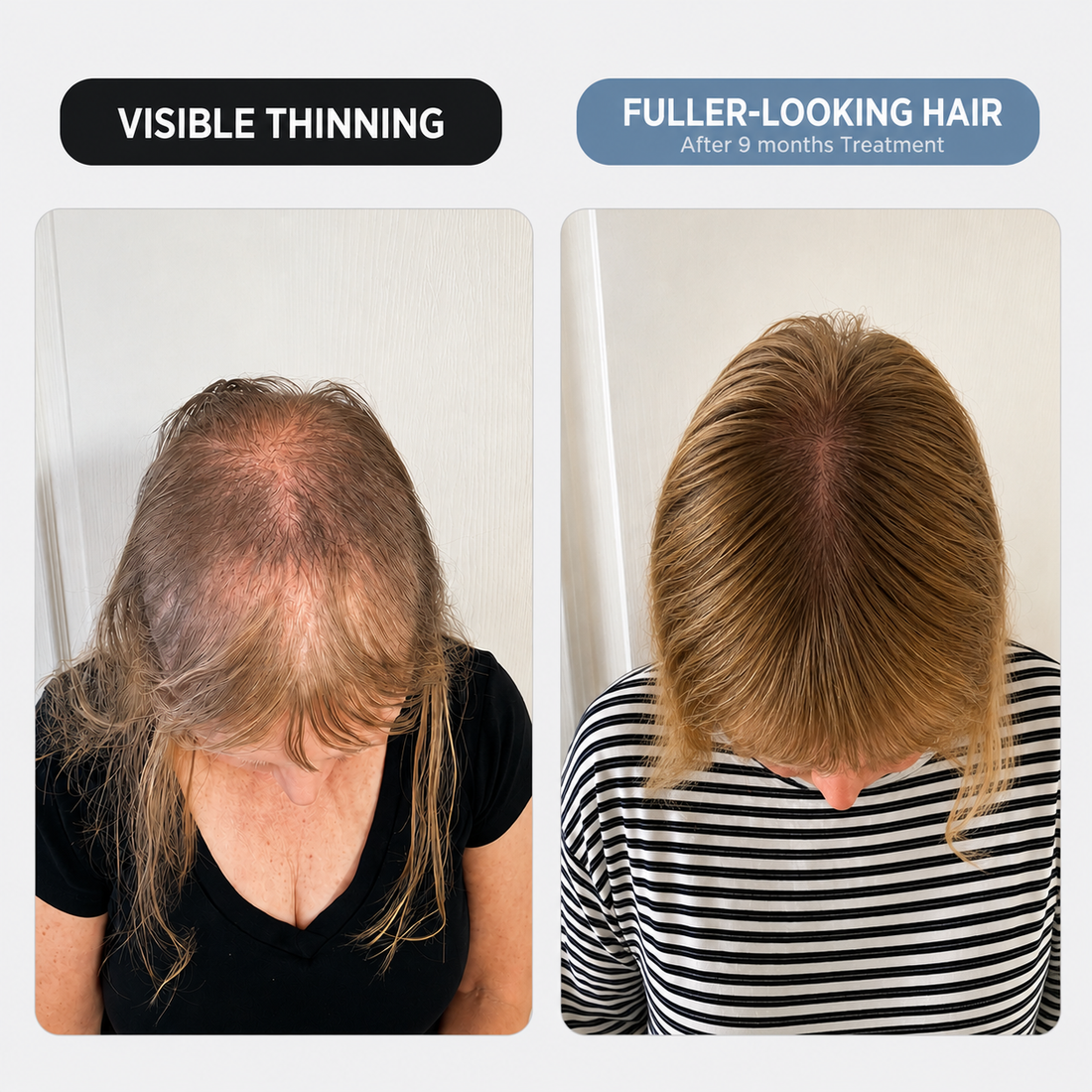 Stop Hiding Your Scalp and Start Styling Your Hair Again